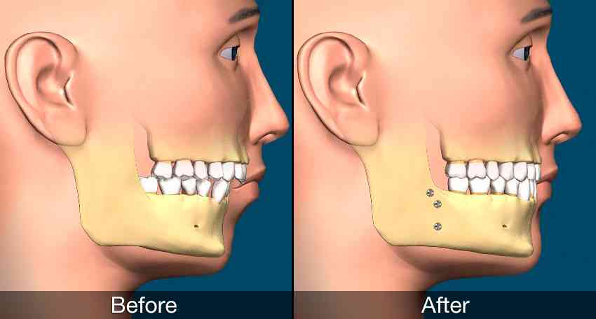 Jaw Straightening Surgery Options Westover Family Dental   Tiny Surgical Orthodontics 