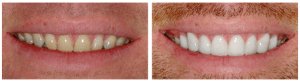 Brighten-stained-teeth