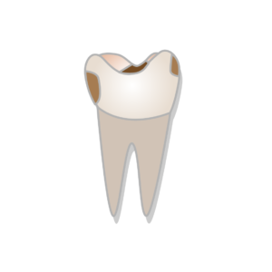 class ii cavity