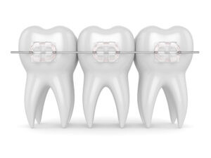 teeth with ceramic clear braces