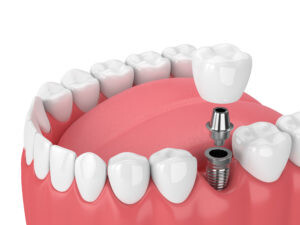jaw with teeth and dental molar implant