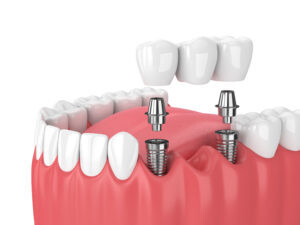 jaw and implants with dental bridge