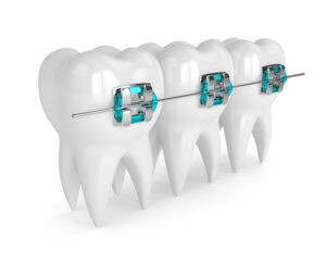 metal braces on teeth
